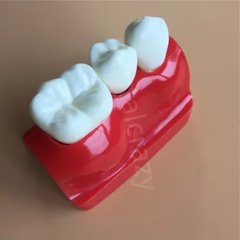 Dentare Preda Implant Analiza Coroana Pod Detașabil Model Dentare Demonstrație Dinți Model