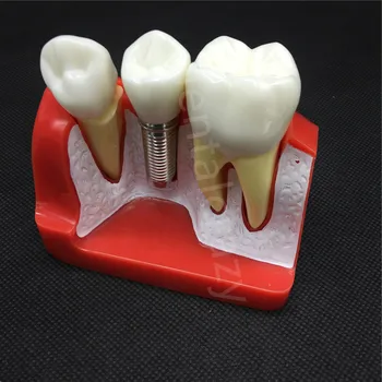 Dentare Preda Implant Analiza Coroana Pod Detașabil Model Dentare Demonstrație Dinți Model